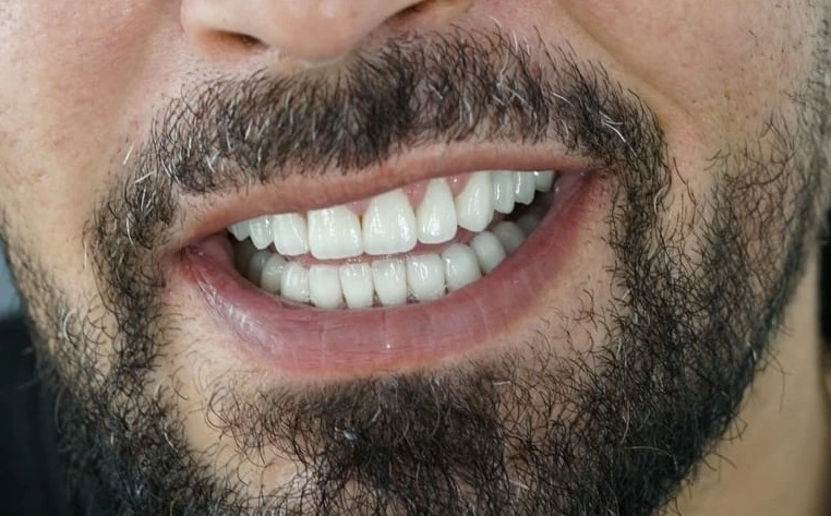 După - Hollywood Smile: fațete emax, coroane dentare & implanturi