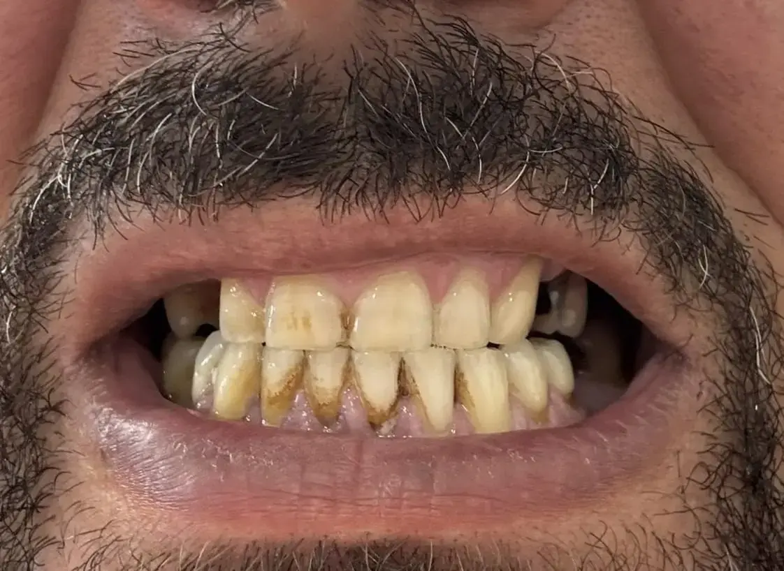 Înainte - Hollywood Smile: fațete emax, coroane dentare & implanturi
